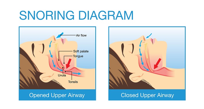 Sleep apnea diagram - Rochester NY dentist
